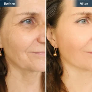 Nurbini® Sleeping V-Face Beauty Device