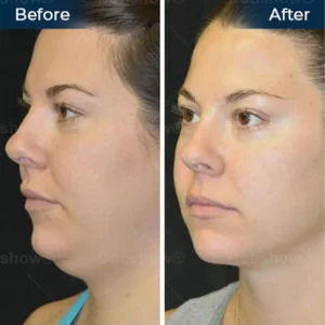 Nurbini® Sleeping V-Face Beauty Device