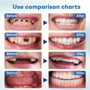 Nurbini® ThermoSeal Fresh Denture - ✅ Clinically proven to completely solve denture slippage and discomfort!