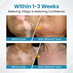 Nurbini®DermaBeam Vitiligo Therapy Device